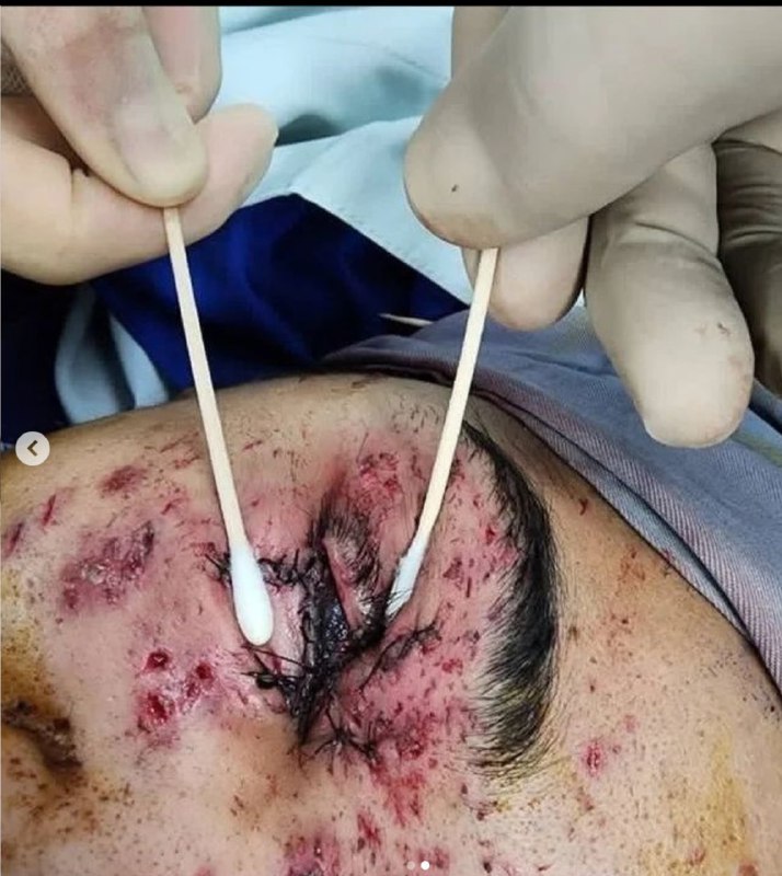 غزل رنجکش، دختر جوان اهل بندرعباس، که در اثر شلیک گلوله ساچمه‌ای به دست نیروهای حکومتی بینایی چشم راست خود را از دست داده، ماجرای زخمی شدن خود را شرح داده است. خانم رنجکش در اینستاگرام نوشته بعد از «چهار ساعت سرکلاس بودن و ۹ ساعت کار» در حال برگشت به خانه بود که هدف گلوله قرار گرفت.او افزوده «آخرین تصویری که چشم راستم ثبت کرد، لبخند اون شخص موقع شلیک کردن بود». این دختر جوان توضیح داده که برای جلوگیری از اصابت گلوله به مادرش در مقابل او ایستاد