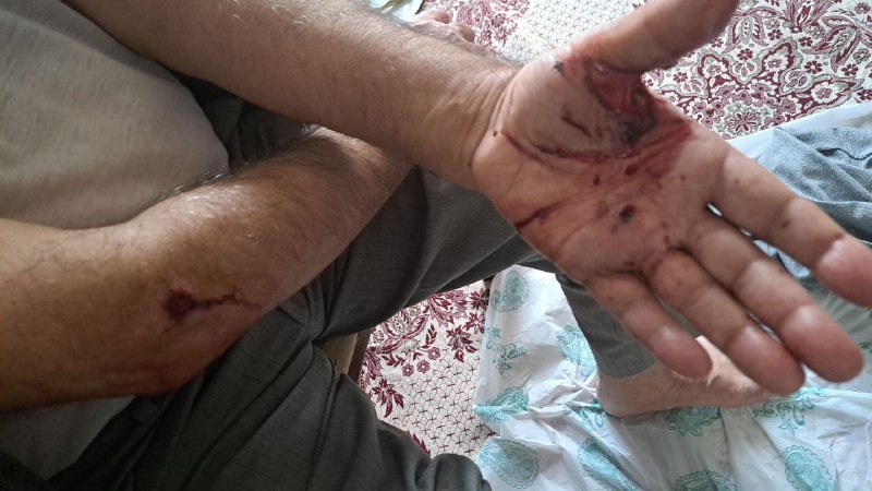 'آثار تیراندازی ماموران در مراسم چهلم #شیرین_علیزاده. عکس اول پای مادر شیرین رو نشون میده. دکتر شخصی آوردیم که ساچمه‌ها رو دربیاره. #اصفهان، ۱۳ آبان' Vahid📡 @VahidOnline'آثار تیراندازی ماموران در مراسم چهلم #شیرین_علیزاده. عکس اول پای مادر شیرین رو نشون میده. دکتر شخصی آوردیم که ساچمه‌ها رو دربیاره. #اصفهان، ۱۳ آبان' Vahid📡 @VahidOnline