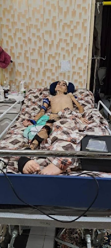 ابوالفضل امیرعطایی فقط ۱۶ سال دارد. در ۳۰ شهریور ۱۴۰۱ در شهرری یک نیروی حکومتی گاز اشک‌آور را از روبه‌رو از فاصله یک متری به سر ابوالفضل شلیک می‌کند.جمجمه سمت چپ کامل ترکیده و یک سری رگ‌های عصبی‌اش تخلیه شده. او در حال حاضر فلج است و فقط چشمانش حرکت می‌کند.این بچه نیاز به یک جراح مغز دارد. کمک کنیم ابوالفضل ۱۶ ساله دوباره حرکت کند. via SalomeSeyednia#ابوالفضل_امیرعطایی📡 @VahidOnlineابوالفضل امیرعطایی فقط ۱۶ سال دارد. در ۳۰ شهریور ۱۴۰۱ در شهرری یک نیروی حکومتی گاز اشک‌آور را از روبه‌رو از فاصله یک متری به سر ابوالفضل شلیک می‌کند.جمجمه سمت چپ کامل ترکیده و یک سری رگ‌های عصبی‌اش تخلیه شده. او در حال حاضر فلج است و فقط چشمانش حرکت می‌کند.این بچه نیاز به یک جراح مغز دارد. کمک کنیم ابوالفضل ۱۶ ساله دوباره حرکت کند. via SalomeSeyednia#ابوالفضل_امیرعطایی📡 @VahidOnline