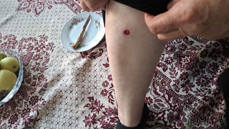 'آثار تیراندازی ماموران در مراسم چهلم #شیرین_علیزاده. عکس اول پای مادر شیرین رو نشون میده. دکتر شخصی آوردیم که ساچمه‌ها رو دربیاره. #اصفهان، ۱۳ آبان' Vahid📡 @VahidOnline'آثار تیراندازی ماموران در مراسم چهلم #شیرین_علیزاده. عکس اول پای مادر شیرین رو نشون میده. دکتر شخصی آوردیم که ساچمه‌ها رو دربیاره. #اصفهان، ۱۳ آبان' Vahid📡 @VahidOnline