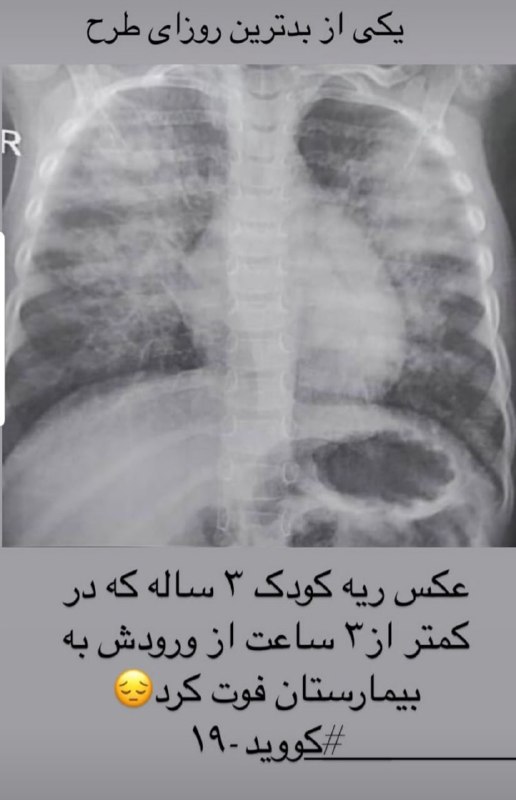 این عکس را امشب یکی از دوستانم در اینستاگرام گذاشته بود. عکس ریه‌ی یک کودک ۳ ساله‌‌ی اهل یکی از شهرهای #خوزستان که دچار #کووید۱۹ شده و کمتر از ۳ ساعت پس از ورود به بیمارستان فوت می‌کند. ریه‌های درگیر کودک را ببینید و کمی بترسید؛ #کرونا این روزها جوان و پیر نمی‌شناسد.#ترس_آگاهانه DrHadiyazdaniدوقلوهای پسرعموم که هنوز دو سالشون نشده، ماه گذشته هر دو بیمارستان بستری بودن به خاطر کووید. پدربزرگ بچه‌ها هم چند هفته قبلش فوت شد.awhitehermes📡 @VahidOnline
