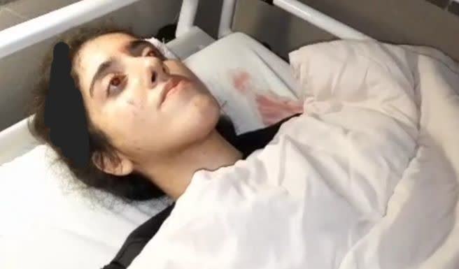 (⚠️خون در عکس دوم)منابع حامی جهوری اسلامی با انتشار  عکس اول مدعی شدند که 'فاطمه.ح، دانشجوی دانشگاه گیلان، در تجمع امروز در اثر ازدحام به زمین افتاده و از ناحیه سر دچار شکستگی مختصری شده و به بیمارستان پورسینا منتقل و پس از مداوای سرپایی مرخص شده و به منزل انتقال یافته است.'Vahidمنظورشون از ازدحام فرار مردم بیچاره از حمله‌ی مامورای بی‌شرف‌شون و تیراندازی‌شونه دیگه؟Nikita_MearsMعکس دوم نسخه واضح عکسی است که من دریافت کرده بودم و در شرحش نوشته بودند در تیراندازی امروز ماموران در #رشت به سرش تیر خورده.همون شهروند به نظر میاد.Vahidدرباره این ماجرا