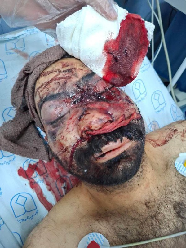 ⚠️تصاویر دلخراش و خونین دریافتی از بیمارستانی در #اصفهانتوییت انگلیسی برای ریتوییت