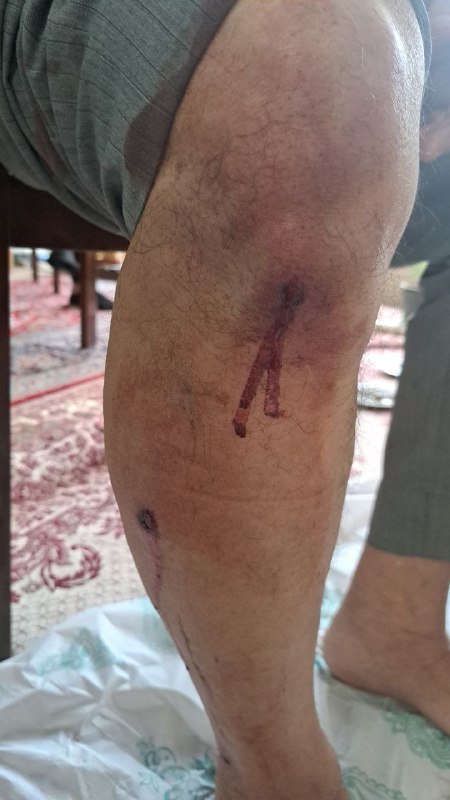 'آثار تیراندازی ماموران در مراسم چهلم #شیرین_علیزاده. عکس اول پای مادر شیرین رو نشون میده. دکتر شخصی آوردیم که ساچمه‌ها رو دربیاره. #اصفهان، ۱۳ آبان' Vahid📡 @VahidOnline'آثار تیراندازی ماموران در مراسم چهلم #شیرین_علیزاده. عکس اول پای مادر شیرین رو نشون میده. دکتر شخصی آوردیم که ساچمه‌ها رو دربیاره. #اصفهان، ۱۳ آبان' Vahid📡 @VahidOnline