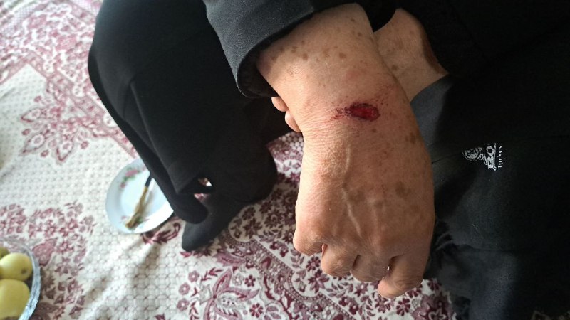 'آثار تیراندازی ماموران در مراسم چهلم #شیرین_علیزاده. عکس اول پای مادر شیرین رو نشون میده. دکتر شخصی آوردیم که ساچمه‌ها رو دربیاره. #اصفهان، ۱۳ آبان' Vahid📡 @VahidOnline'آثار تیراندازی ماموران در مراسم چهلم #شیرین_علیزاده. عکس اول پای مادر شیرین رو نشون میده. دکتر شخصی آوردیم که ساچمه‌ها رو دربیاره. #اصفهان، ۱۳ آبان' Vahid📡 @VahidOnline