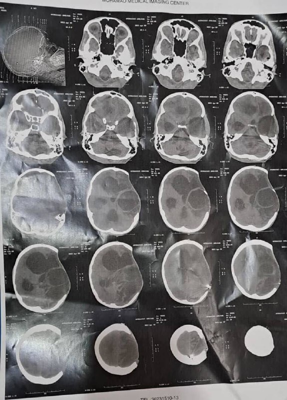 ابوالفضل امیرعطایی فقط ۱۶ سال دارد. در ۳۰ شهریور ۱۴۰۱ در شهرری یک نیروی حکومتی گاز اشک‌آور را از روبه‌رو از فاصله یک متری به سر ابوالفضل شلیک می‌کند.جمجمه سمت چپ کامل ترکیده و یک سری رگ‌های عصبی‌اش تخلیه شده. او در حال حاضر فلج است و فقط چشمانش حرکت می‌کند.این بچه نیاز به یک جراح مغز دارد. کمک کنیم ابوالفضل ۱۶ ساله دوباره حرکت کند. via SalomeSeyednia#ابوالفضل_امیرعطایی📡 @VahidOnlineابوالفضل امیرعطایی فقط ۱۶ سال دارد. در ۳۰ شهریور ۱۴۰۱ در شهرری یک نیروی حکومتی گاز اشک‌آور را از روبه‌رو از فاصله یک متری به سر ابوالفضل شلیک می‌کند.جمجمه سمت چپ کامل ترکیده و یک سری رگ‌های عصبی‌اش تخلیه شده. او در حال حاضر فلج است و فقط چشمانش حرکت می‌کند.این بچه نیاز به یک جراح مغز دارد. کمک کنیم ابوالفضل ۱۶ ساله دوباره حرکت کند. via SalomeSeyednia#ابوالفضل_امیرعطایی📡 @VahidOnline